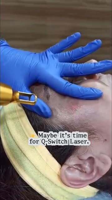 ✨ Stubborn Dark Spots? Q-Switch Laser Treatment Can Help!

Dark spots, pigmentation and uneven skin 