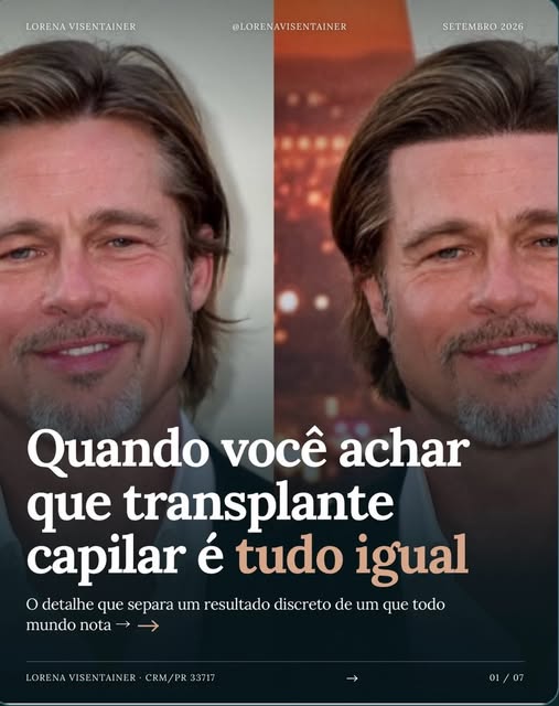 Transplante capilar não é tudo igual, é um trabalho com muita técnica, olhar artístico e muita exper