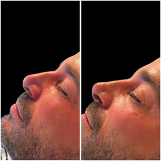 👃✨ A veces, un pequeño cambio puede hacer que todo el rostro se vea más equilibrado y en esto es ex