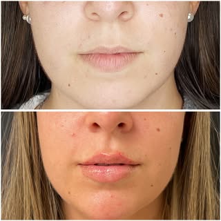 💋 El aumento de labios puede ser uno de los tratamientos en los que más podemos reflejar nuestra fi