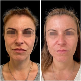 ✨ Hay tratamientos que cambian un rostro. Y otros que simplemente hacen que vuelvas a parecer tú… pe