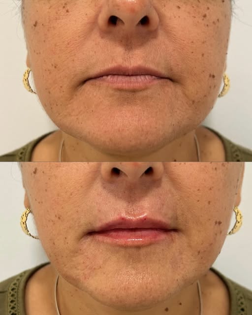 ✨Rejuvenecimiento perioral✨

👄Los labios con el tiempo van perdiendo consistencia y volumen, inclus