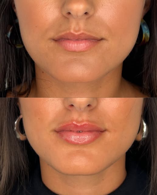 ✨Tratamiento de Labios ✨

En este caso partíamos de una paciente joven con una ligera asimetría en e