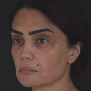 ✨Face Lift, Fat Injection, Blepharoplasty

Op. Date: 09.12.24
Pre-op: 04.12.24
Post-op: 12.02.25

.
