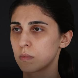 ✨Endoscopic Forehead Lift,
Fat Injection, Rhinoplasty
✨Post-op 1 year 

Op. Date: 16.08.24
Pre-op: 1