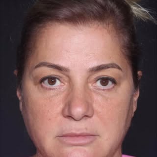 ✨Face Lift & Upper Blepharoplasty (3rd year)

Op. Date: 02.11.23
Pre-op: 31.10.23
Post-op: 25.02.26

