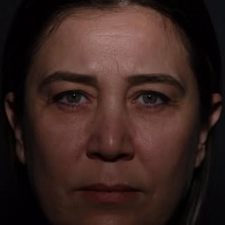 ✨Endoscopic Forehead Lift,
Upper Blepharoplasty,
Direct Brow Lift.

✨Post-op 3 Months

Op. Date: 11.