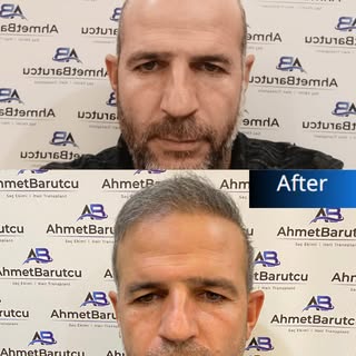 Ahmet Barutcu Saç Ekimi | Hair Transplant

📌 Muayenemiz ücretsizdir. | Our inspection is free.

Saç