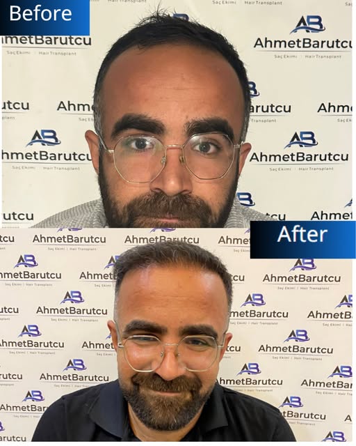 Ahmet Barutcu Saç Ekimi | Hair Transplant

📌 Muayenemiz ücretsizdir. | Our inspection is free.

Saç