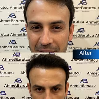Ahmet Barutcu Saç Ekimi | Hair Transplant

📌 Muayenemiz ücretsizdir. | Our inspection is free.

Saç