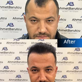Ahmet Barutcu Saç Ekimi | Hair Transplant

📌 Muayenemiz ücretsizdir. | Our inspection is free.

Saç