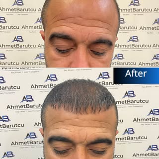 Ahmet Barutcu Saç Ekimi | Hair Transplant

📌 Muayenemiz ücretsizdir. | Our inspection is free.

Saç