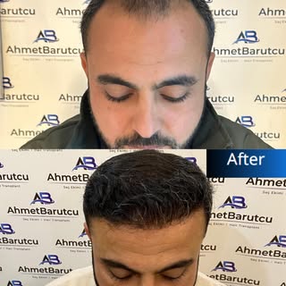Ahmet Barutcu Saç Ekimi | Hair Transplant

📌 Muayenemiz ücretsizdir. | Our inspection is free.

Saç