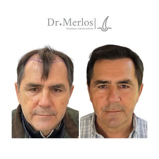 Un cambio que va más allá del cabello: con un injerto capilar, rejuveneces, recuperas la confianza y