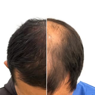 A tan solo 6 meses del injerto capilar.
Antes y después que impacta ✨
Hoy te compartimos un caso de 