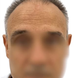 ✨ CASO DE ÉXITO: RELLENO FRONTAL + FRONTAL EXTENDIDO + ENTRADAS ✨
🔬 En nuestra clínica, cada proced