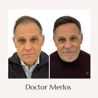 Resultado post injerto capilar. Planificación individualizada, diseño de línea frontal acorde a la f