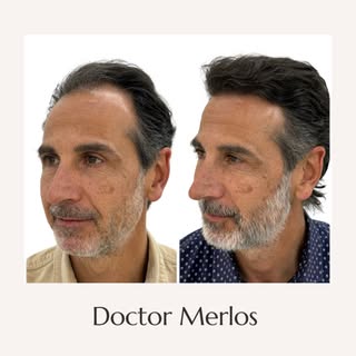 Recuperar el cabello es también recuperar seguridad y confianza.

En este caso, realizamos un injert