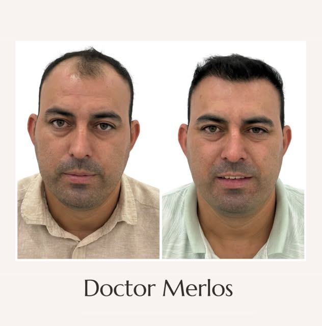 ✨ injerto capilar 10 meses de evolución 

Un resultado natural no consiste simplemente en recuperar 
