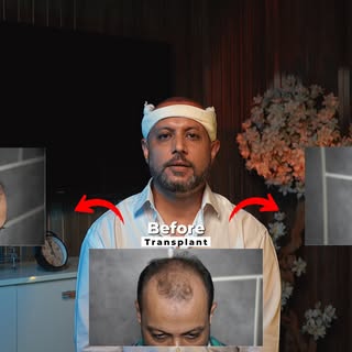 Just 3 days into his hair transplant journey, and Nasim Majid from Rawalpindi is already thrilled wi