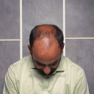 Ever wondered what actually happens during a hair transplant? This video takes you through the entir