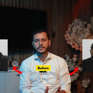 Meet Mr. Sayam from Rawalpindi — 6 months post hair transplant, and the transformation speaks for it