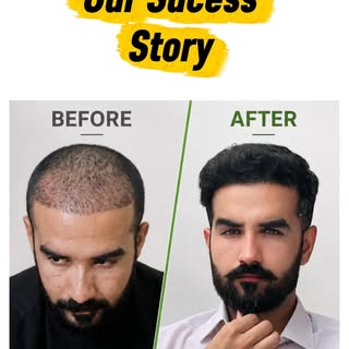 Another incredible transformation at Hair Plus International! Our client's journey from hair loss to