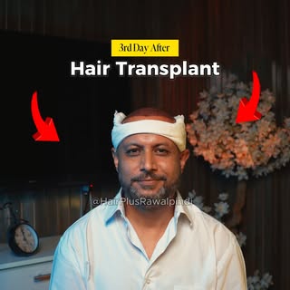 Day 0 → Day 3 → Day 14 ✨
Real patient. Real results. Real healing journey.

Hair restoration is a pr