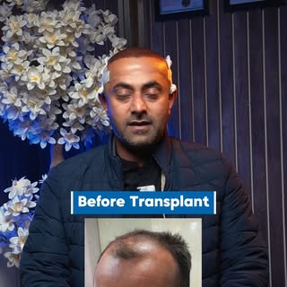 Meet Mr. Rashid Ali from Mandi Bahauddin, sharing his experience just 3 days after his hair transpla