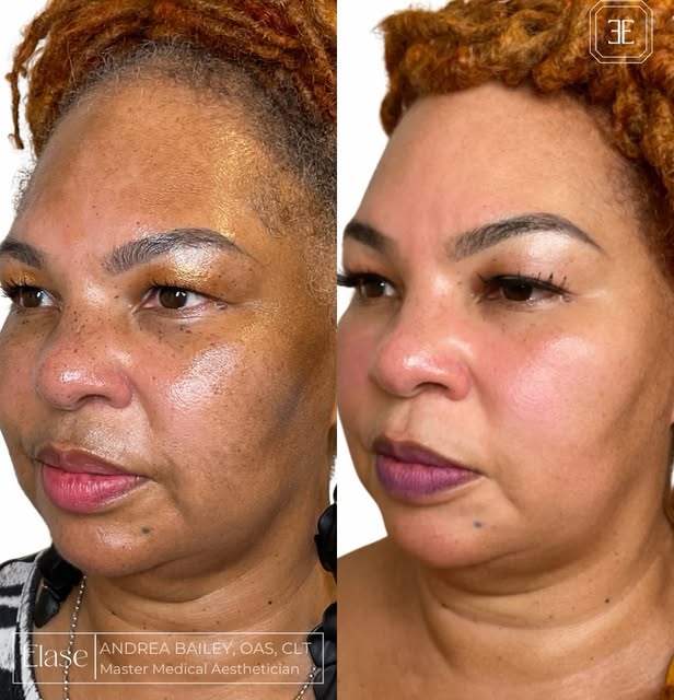 Skin Health Restoration💎
by @andreabailey_glam 
This beautiful patient is currently experiencing ha