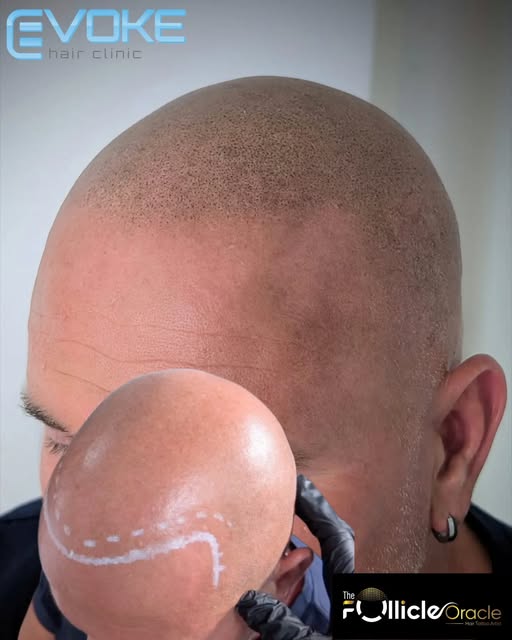 What do to if you dont like being bald and are happy keeping your head shaved??? Get SMP ofcourse‼️
