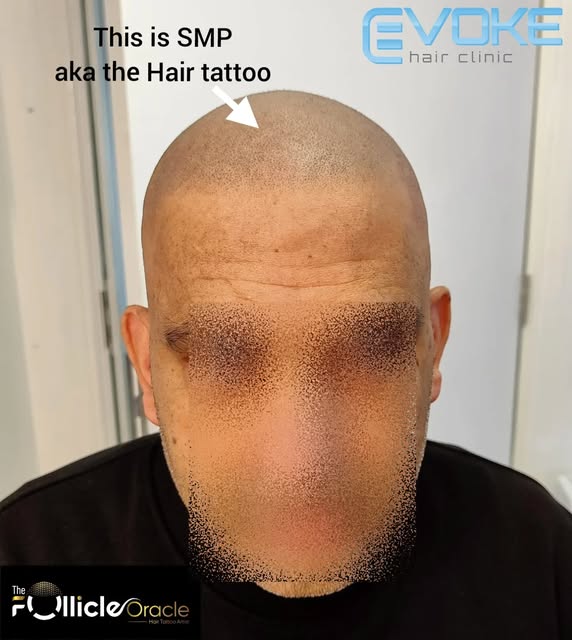 SMP on Asian skin. A slightly straighter hairline than we would plan on most Caucasian clients but s