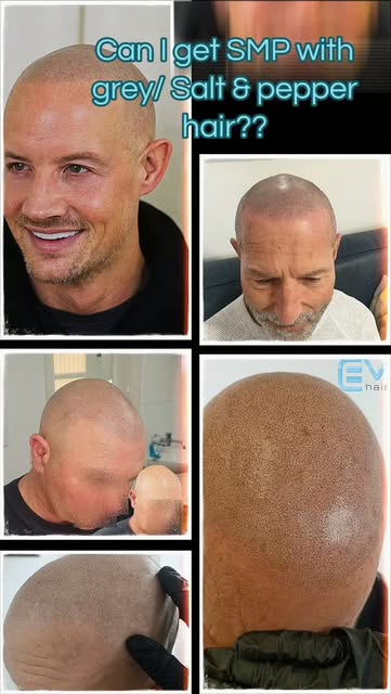 SCALP MICROPIGMENTATION ON SALT & PEPPER HAIR? No problem! 

When kept at a closely shaved level, th