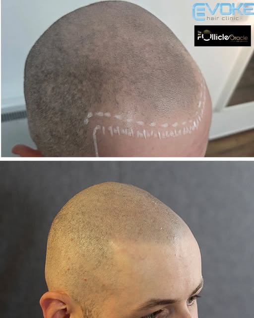 This lovely young chap started losing his hair and it was a real confidence killer for him. He liked