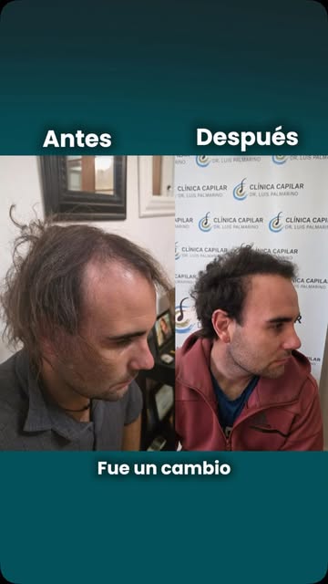 👉🏼 Un cambio increíble.

Vos también podés recuperar tu pelo y tu seguridad, escribinos.