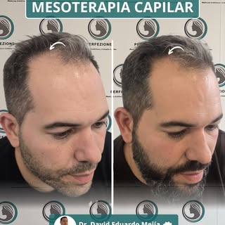 Este paciente presentaba una pérdida difusa de densidad en la zona frontal y la coronilla, lo que af