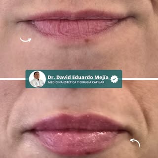 Russian Lips • Definición sutil, resultado estable✨

A esta paciente se le infiltró relleno con ácid
