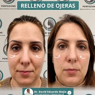 ✨ Una mirada más luminosa puede cambiarlo todo.

El relleno de ojeras es un tratamiento pensado para