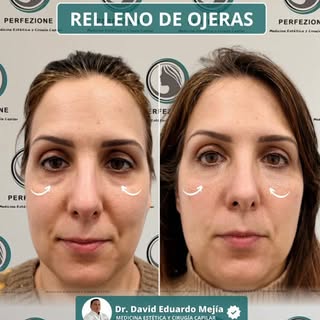 Relleno de ojeras con Algeness