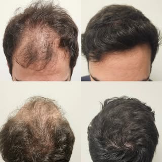 Antes e Depois de Transplante Capilar Masculino

📋 Informação técnica:

✍️ FUE de 3230 Unidades Fol