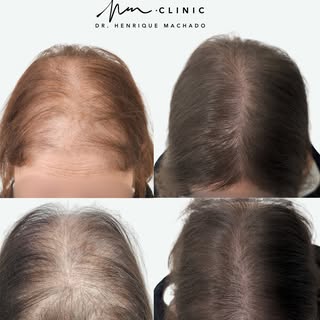 Antes e Depois de transplante capilar feminino 👩🏻

Nos casos de alopecia feminina, devemos ter em 