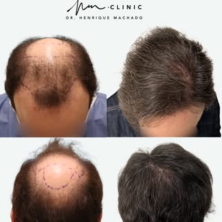 Antes e Depois de transplante capilar 🙋🏻‍♂️

Nesta ocasião apresentamos um caso de redensificação 