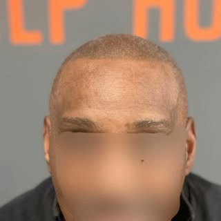 Meeting so many professionals in the scalp micropigmentation industry has been a fantastic experienc