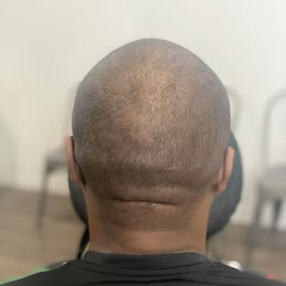 Do you need your scar concealed on your scalp? Not a problem for Scalp Authority. Schedule a free co