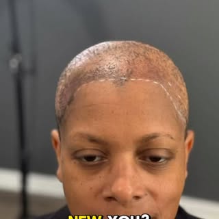 🌟 Transforming Confidence: A Journey with Alopecia 🌟

✨ Before & After: Scalp Micropigmentation ✨
