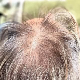 The silent sting of hair loss can erode a woman’s radiance, each thinning strand stealing a piece of