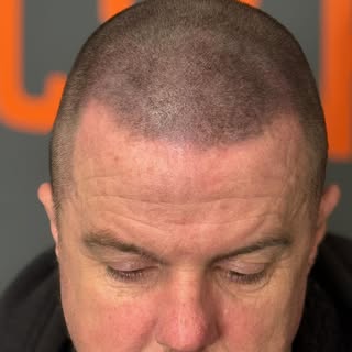 “Struggling with thinning hair? 💔 Scalp micropigmentation is your game-changer! 💪 Tiny pigment dot