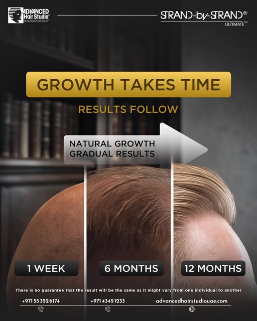 Hair restoration is a gradual process.

After a hair transplant, the transplanted follicles go throu