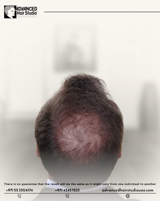 Ignoring genetic hair loss can allow thinning to progress over time.

But you don’t have to wait unt