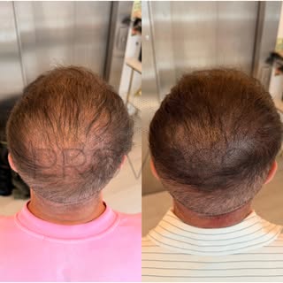Before & after 🤩 #smp #beforeandafter #scalpmicropigmentation
